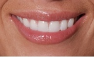 close up of a smile with dental crowns
